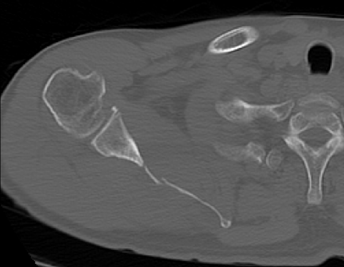 Rt Shoulder Axial Scan image