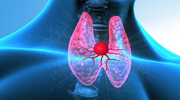 갑상선암 방사성 요오드 동위원소치료 후 격리 I-131 유두암 여포암 치료 효과 부작용 예후 준비 분화암 타이로젠 제한식 갑상선 전절제술 재발 방지 뜻 식단