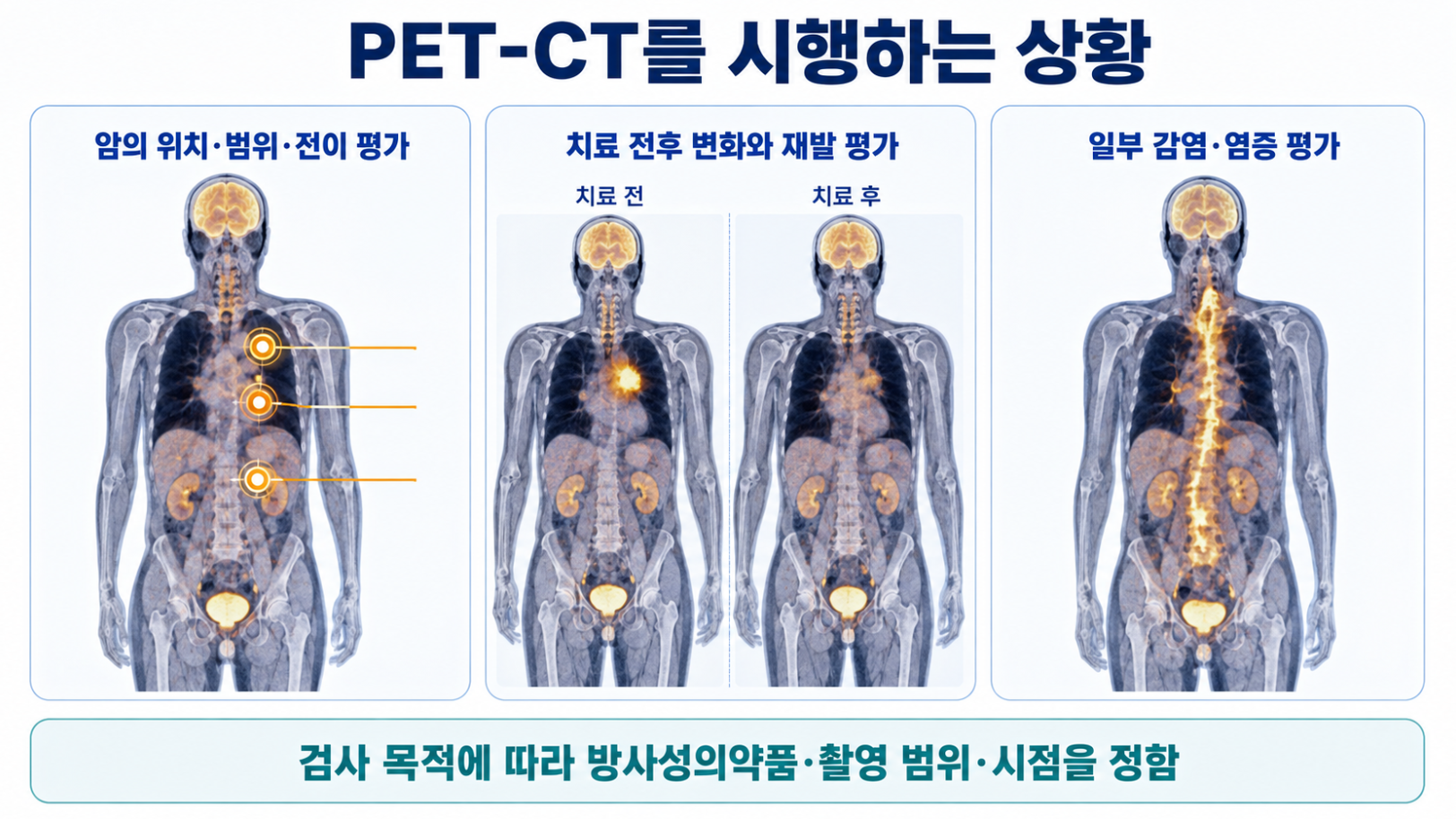 암의 위치와 범위, 치료 전후 변화, 일부 감염·염증 평가 등 PET-CT 시행 상황을 설명한 이미지