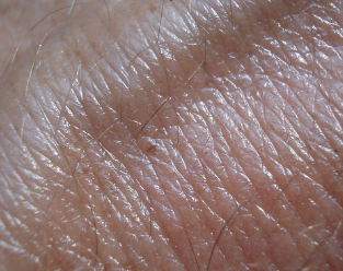 피부암 초기증상 6