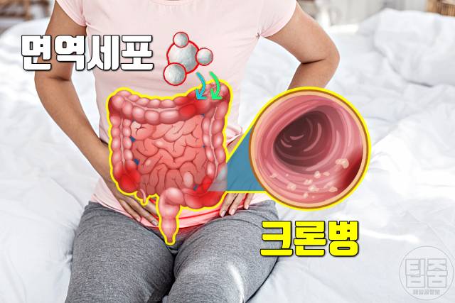 장염 걸리는 이유 자가면역질환 크론병 장염 원인 장내 미생물 불균형