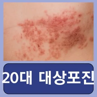 대상포진 감염 증상 부위 손 허리 허벅지_23