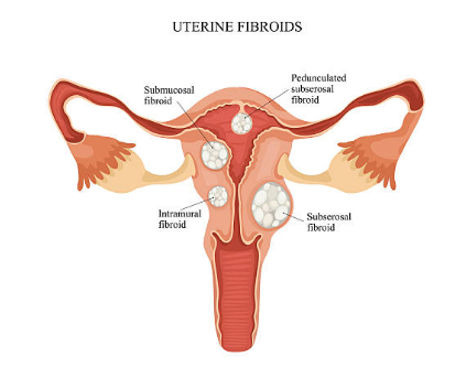 자궁근종 증상, 수술후 회복기간, 크기별 치료 총정리 (2024ver)
