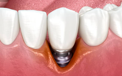 오스템 임플란트 가격, 종류