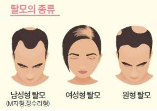 미녹시딜-효과