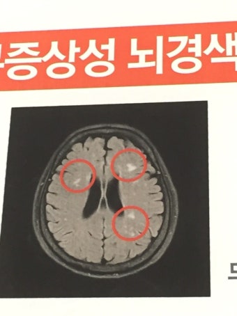 뇌썩음이 무엇인가?