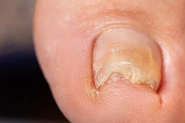 내성발톱 자가치료 에서도 가능한 실질적인 방법들을 알아봤습니다. 내성발톱 자가치료, 고통 없이 집에서 해결할 수 있는 방법이 궁금하신가요? 발톱이 피부 속으로 파고드는 불편함에서 벗어나고 싶다면, 이제부터 제가 알려드릴 몇 가지 간단하지만 효과적인 자가치료 방법들에 주목해 보세요.