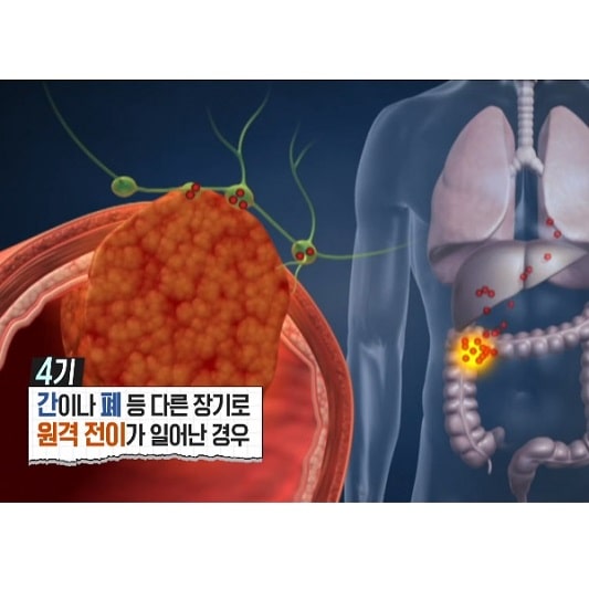 대장암 증상