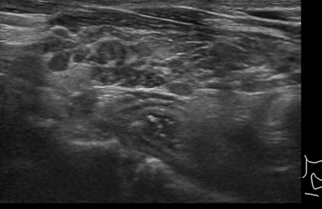 갑상선 기능 저하증