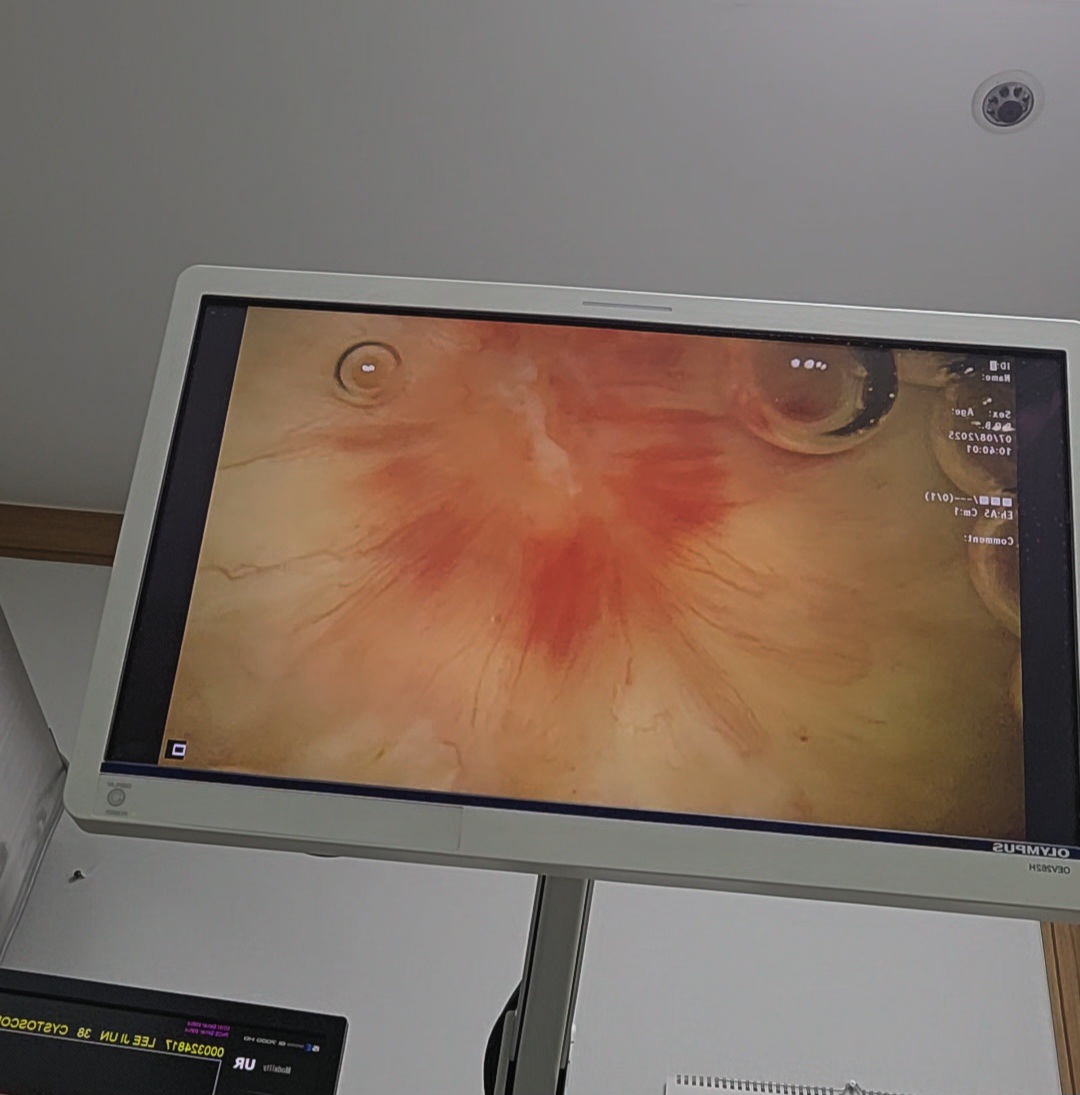 방광 내시경 수술 회복부위