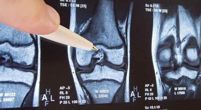 무릎 관절염 증상