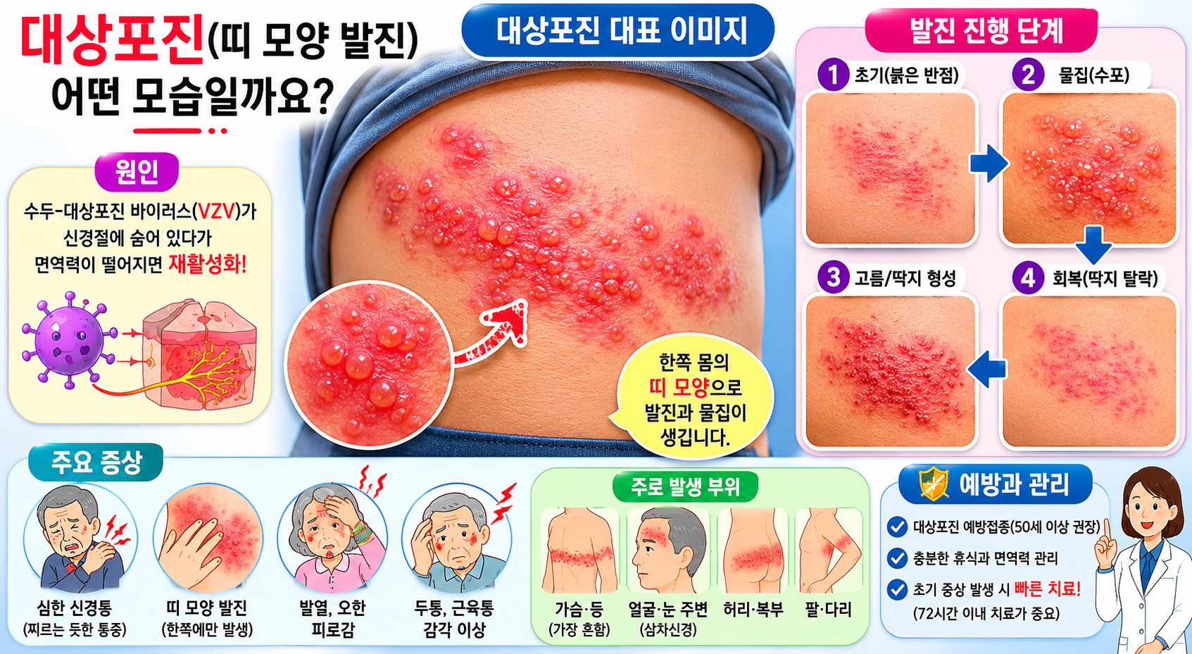 대상포진 단계 설명