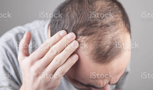 보령시 탈모 치료비