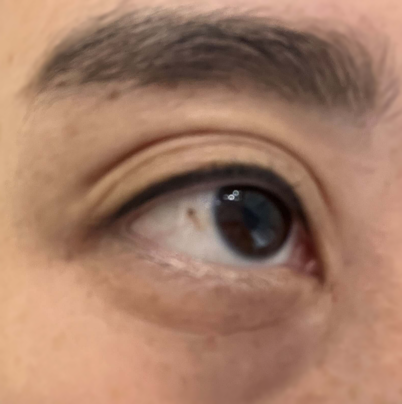 눈에 생긴 점 제거하기 전