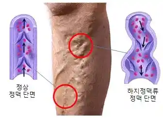 하지정맥류-설명