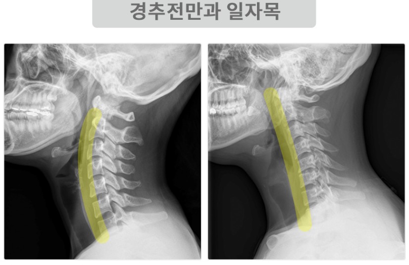 뻐근한 목 통증, 거북목 일자목 증상일까? 목디스크에 좋은 신전동작, 나쁜자세 운동