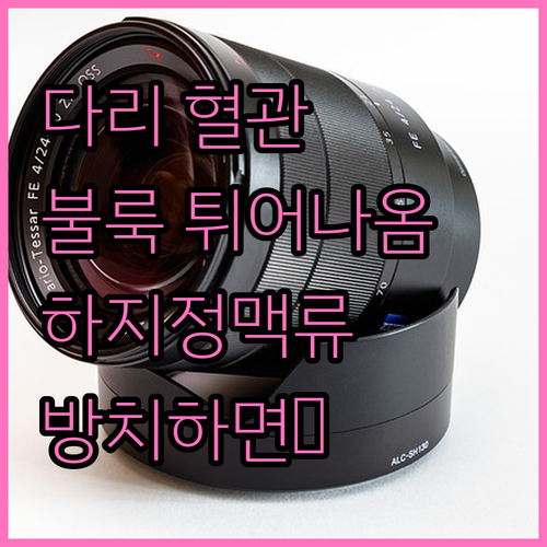 하지정맥류 원인부터 증상, 치료 시기