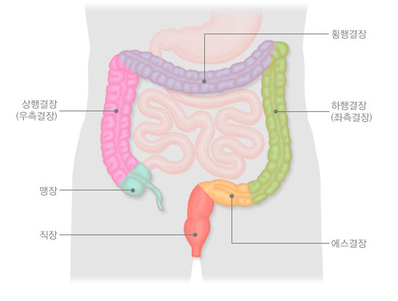 대장암