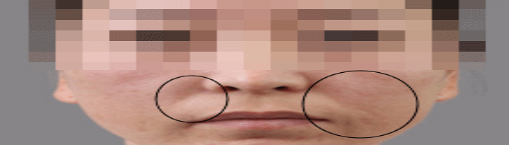 물광주사 맞기 전 사진