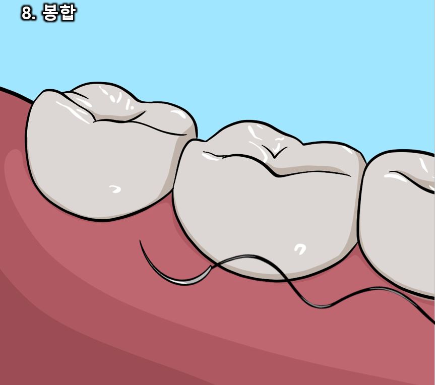 사랑니 발치 과정과 통증, 신경 손상에 대한 모든 것