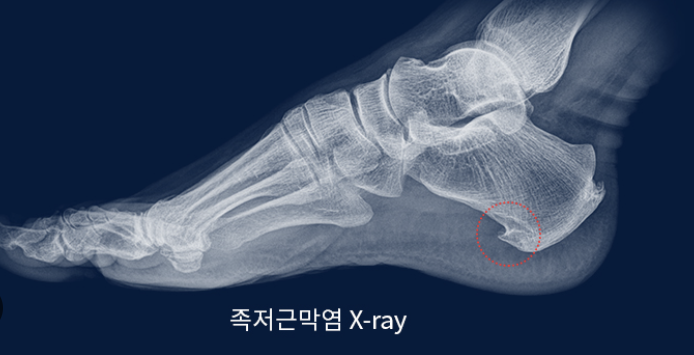 족저근막염의 원인 증상과 해결 방법