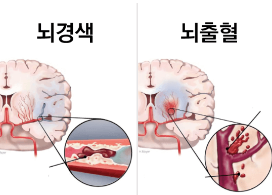 뇌경색원인