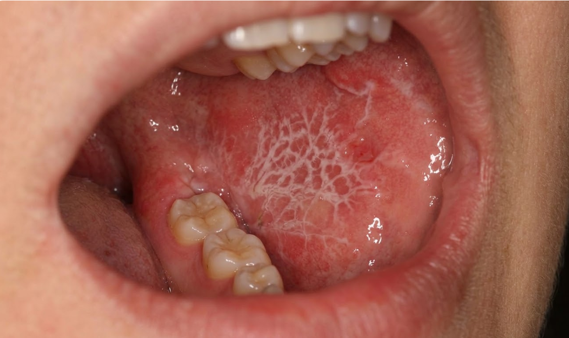 구강암 조기 발견의 중요성