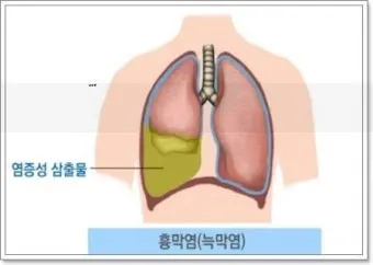 늑막에 물이 차는 이유와 치료 방법_24
