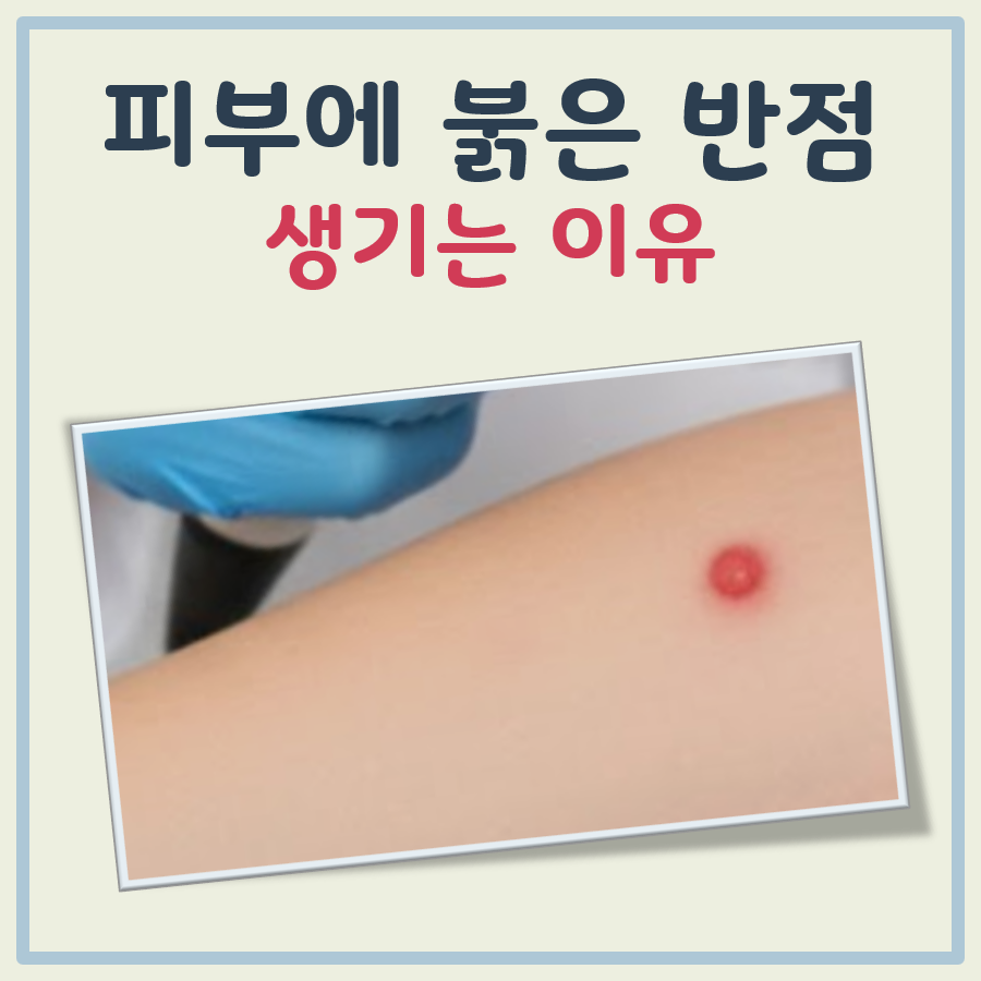 피부에 붉은반점이 생기는 이유 대표 이미지