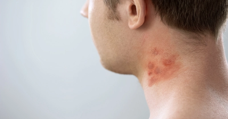 목에 접촉성 피부염이 난 남자
