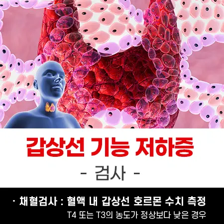 갑상선 기능 저하증 검사