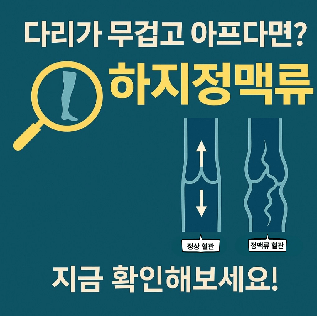 하지정맥류