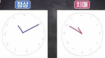 정상인과 치매환자의 시계 그림 2