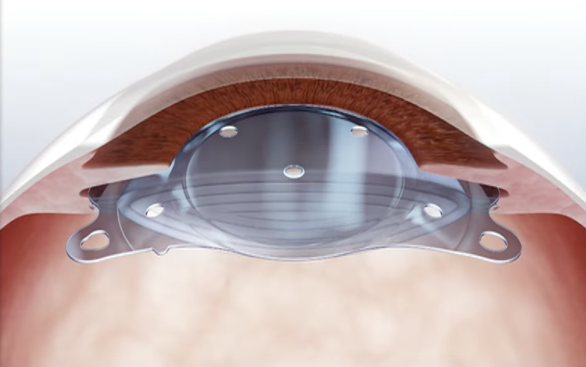 시력교정술 종류 라섹 라식 스마일 장단점 비교