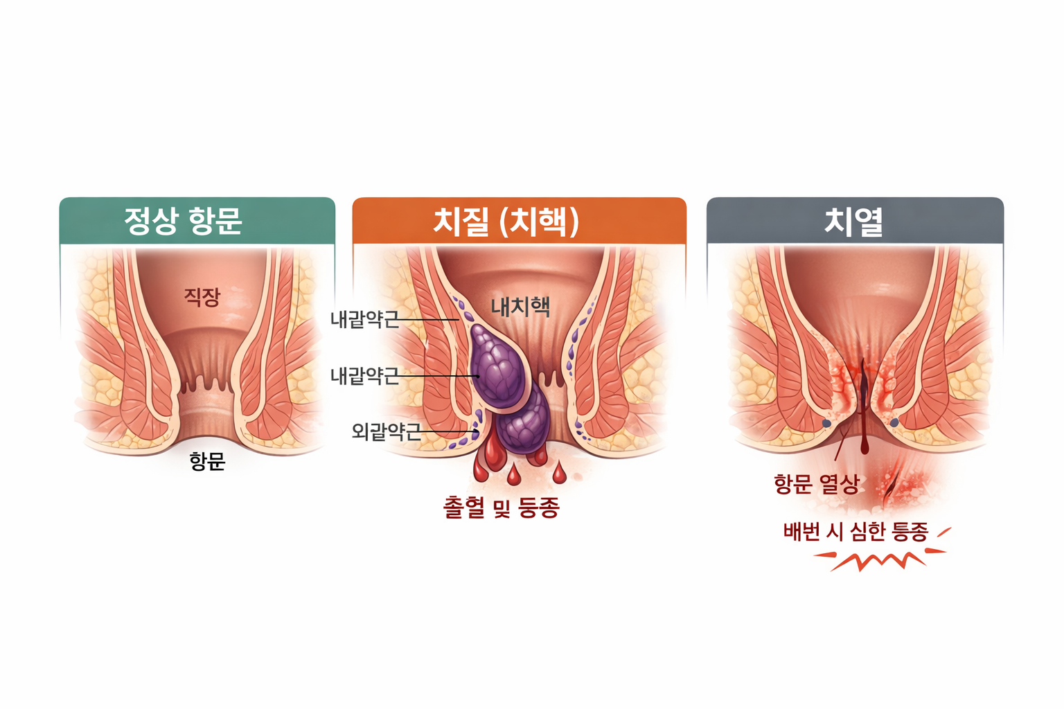 치질과 치열 구조 일러스트