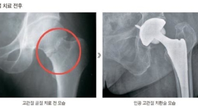 고관절 이미지