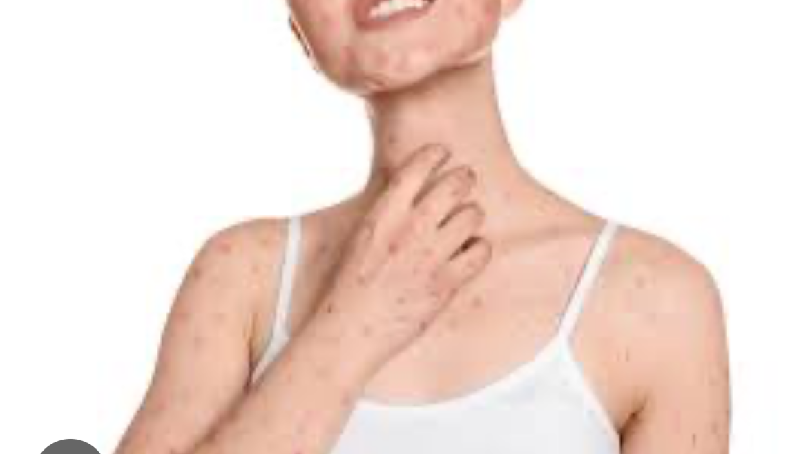 엠폭스-발생국가-발생원인