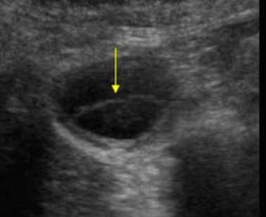 괴저성 담낭염 (Gangrenous cholecystitis)