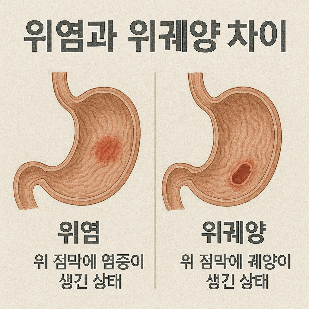 위염과 위궤양의 차이와 관리법