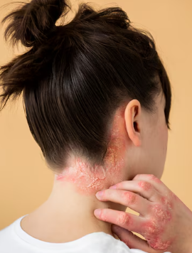 피부 붉은반점 31