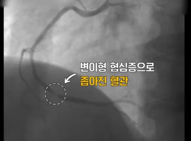 변이형협심증