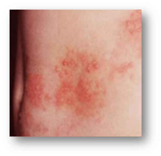  대상포진 초기증상1