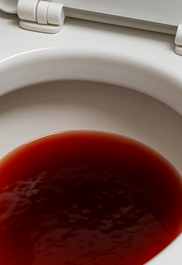 방광암 초기증상