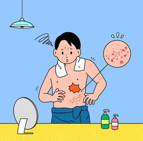 대상포진 발병 이미지