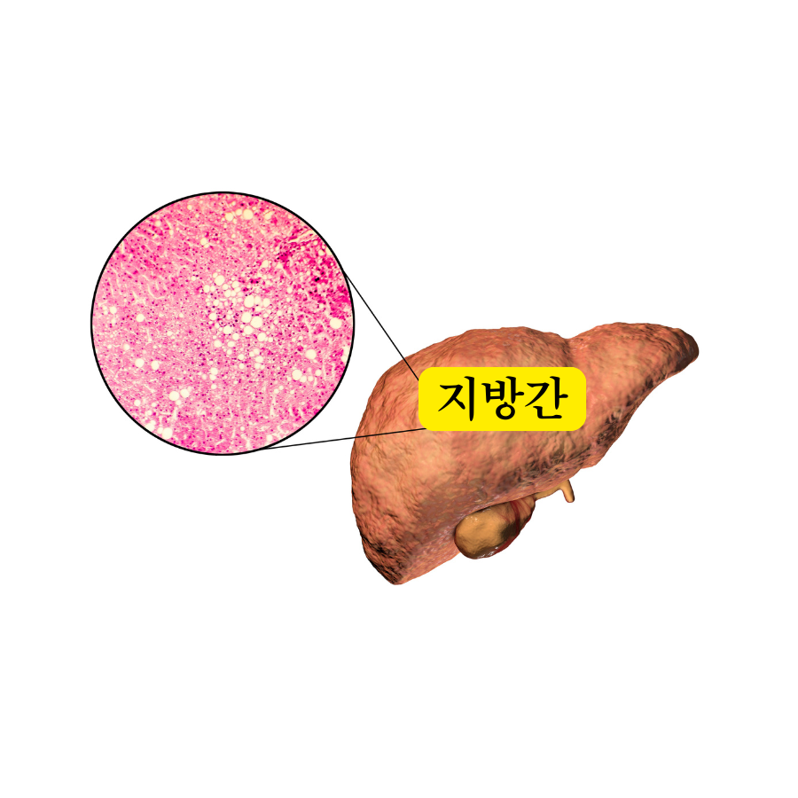 지방간