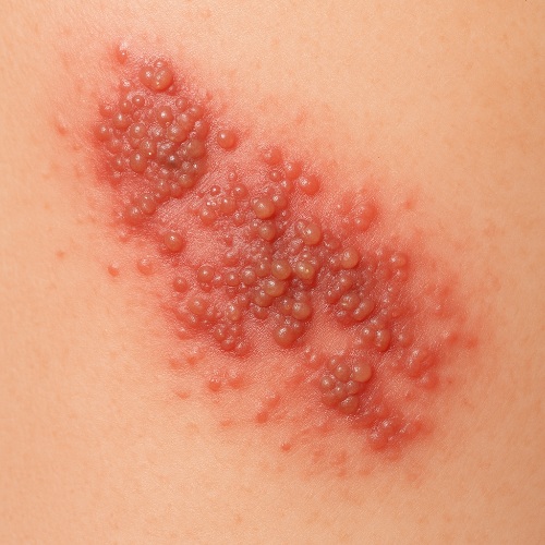 띠모양을-이루며-수포가-생긴-모습