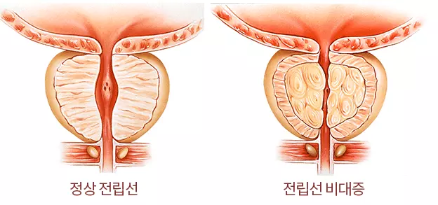 전립선비대증