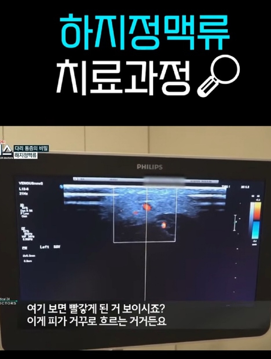 EBS-명의-박기혁-교수-하지정맥류