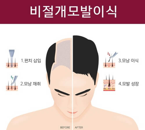 모발이식 3000모 비용
