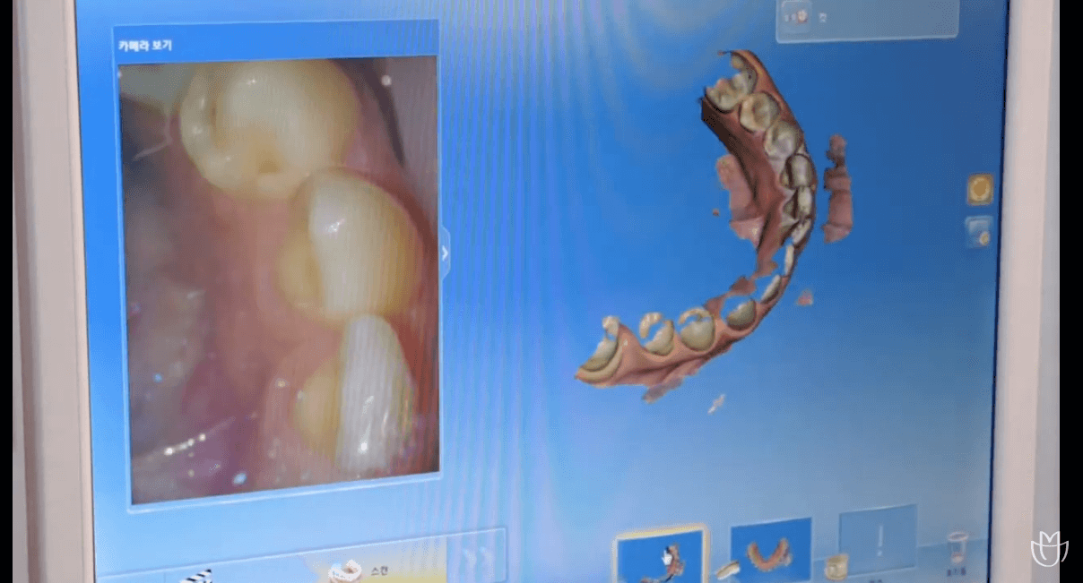 미니쉬 시술 과정